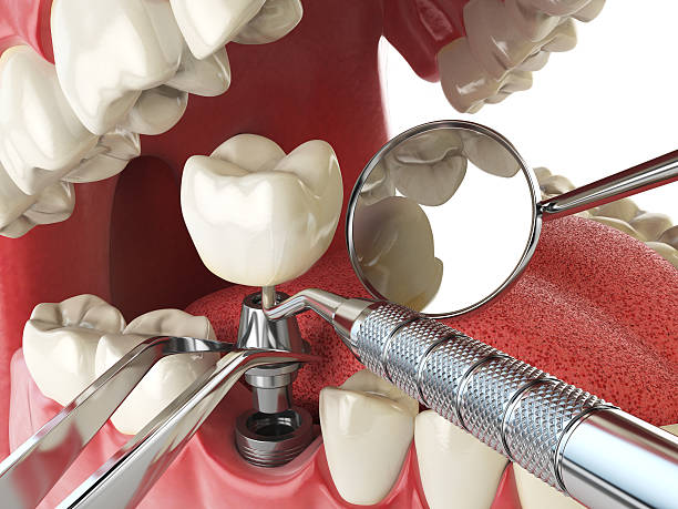 Best Emergency Tooth Extraction in Savoy, IL